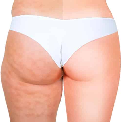 Mesoterapia-EDIT
